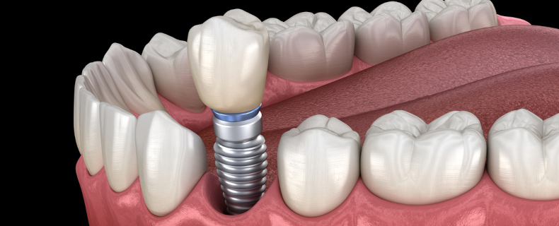 What are the Benefits of Same-Day Dental Implants? - Christine Tenaglia ...