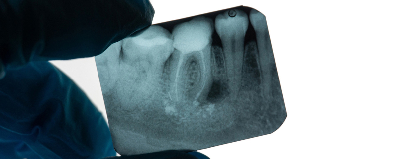 What Is A Root Canal And Why Are They Needed? - Christine Tenaglia, Dds